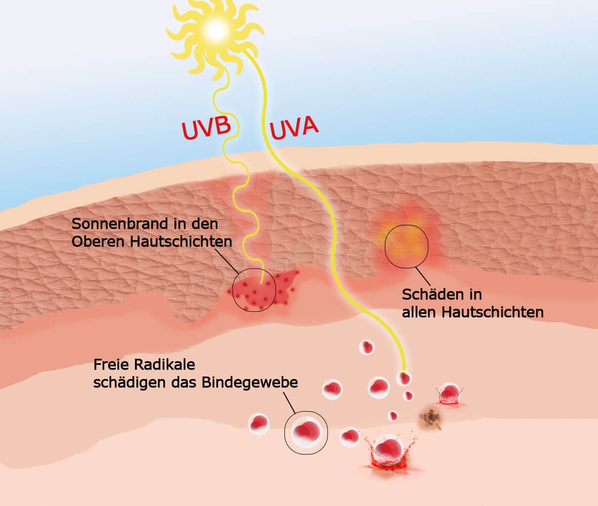 Под действием ультрафиолетовых лучей у человека появляется. Воздействие УФ излучения на кожу. Воздействие УФ лучей на кожу. Влияние солнечных лучей на кожу. Солнечное излучение на кожу.